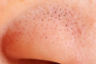 Black Heads