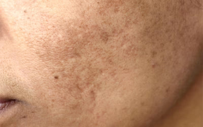 Pigmentation