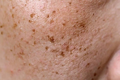 Dark Spots