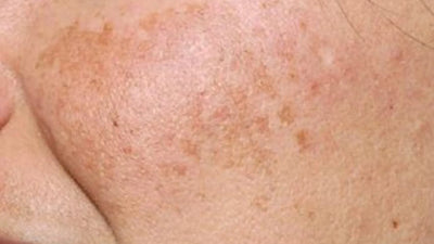 Melasma
